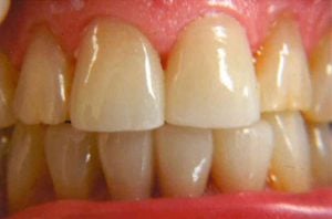 Full restoration of the lower dental arch with a healthy-looking set of ceramic crowns in a light, natural shade