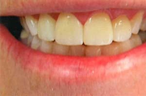 Frontal view of a smile featuring symmetrical gum levels and upper central incisors restored with bright white, uniform cosmetic veneers.