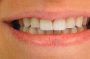 A broad smile showing perfectly aligned, bright white teeth with improved anatomical shape and fuller arch coverage