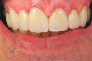 Close-up of an upper dental arch with a dental bridge or implant restoring a missing tooth with a natural-looking, color-matched porcelain replacement.