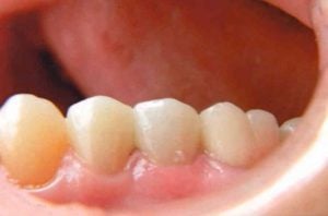 A molar tooth restored with a metal-free porcelain crown that blends seamlessly with the color and translucency of the natural teeth