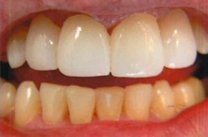 Complete restoration of the upper arch using a bright white dental bridge that fills all gaps and provides a uniform color