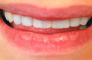 Full cosmetic dental rehabilitation of the upper teeth with bright, perfectly shaped, and polished white porcelain veneers.