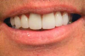 A man's smile featuring a straight upper row of teeth with consistent length and a bright, professionally whitened shade.