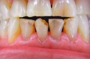 Close-up of lower teeth exhibiting severe brown staining, heavy enamel wear, and visible decay along the gum line