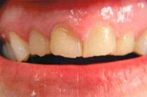 Macro view of front teeth showing an uneven gum line and a central incisor with a chipped biting edge and yellowish tint
