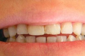 A smile featuring small, slightly yellowed teeth with minor spacing gaps between the front incisors