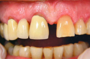 Extreme close-up of a patient’s upper arch with a significant gap where a lateral incisor is missing and the adjacent teeth are discolored.