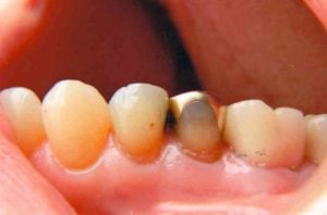 Side view of a molar tooth with a deep visible cavity and a deteriorating dark silver amalgam filling