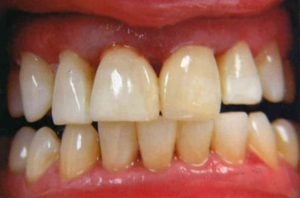 Close-up of a dental arch with multiple gaps between teeth and a severely discolored, dark incisor showing heavy internal staining.