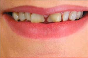 A woman's smile highlighting a central incisor with a large fracture on the corner and a dark, failing dental filling.
