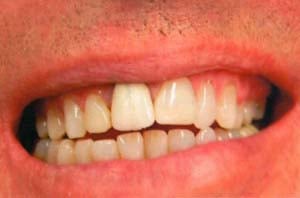 A man's smile displaying crowded upper teeth with worn, jagged edges and irregular alignment.