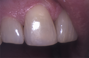The result of the previous case, where the front tooth has been restored with cosmetic bonding or a veneer, recreating a smooth, natural edge