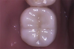 A molar tooth with a clean, tooth-colored porcelain inlay that replicates the natural grooves and pits of healthy enamel.
