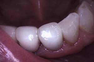 A professional result showing the premolar after a composite resin filling, where the material is indistinguishable from the surrounding natural tooth structure.