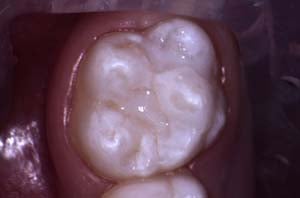 A molar with a fresh, bright white protective dental sealant covering the pits and fissures to prevent future decay