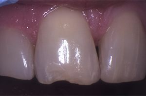 A close-up of a front tooth with a significant notch or incisal chip on the biting edge, showing a loss of enamel