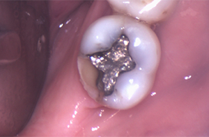 A high-angle view of a lower molar containing a large, failing silver amalgam filling with visible fractures and recurrent decay on the side