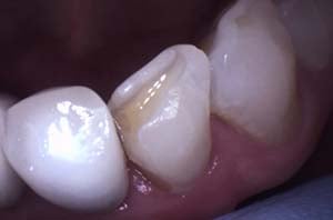 A side view of a premolar with a visible cavity forming on the chewing surface, appearing as a dark, shadowed indentation