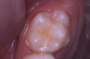 An intraoral shot of a molar with a worn dental sealant and yellowish staining in the pits and fissures